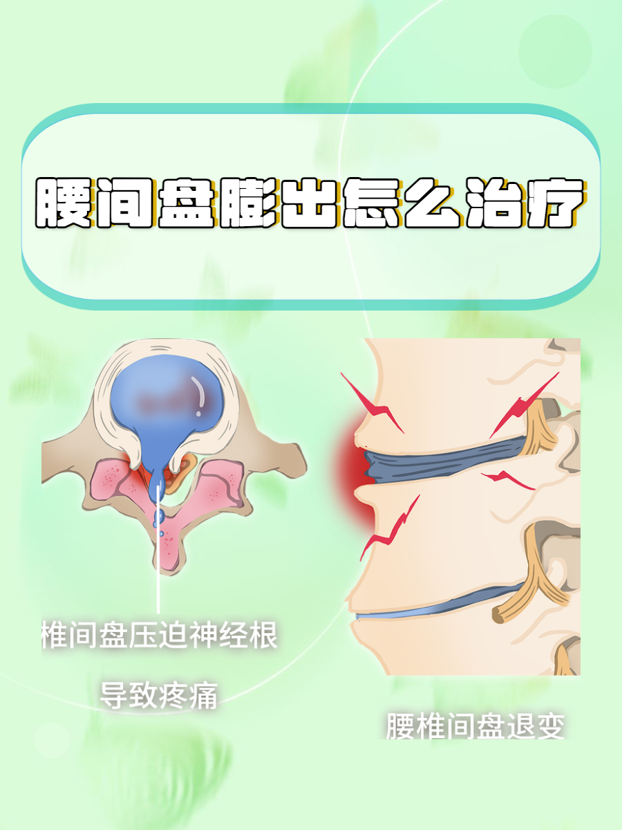 腰间盘膨出指的是腰椎间盘的外层纤维环虽未完全破裂