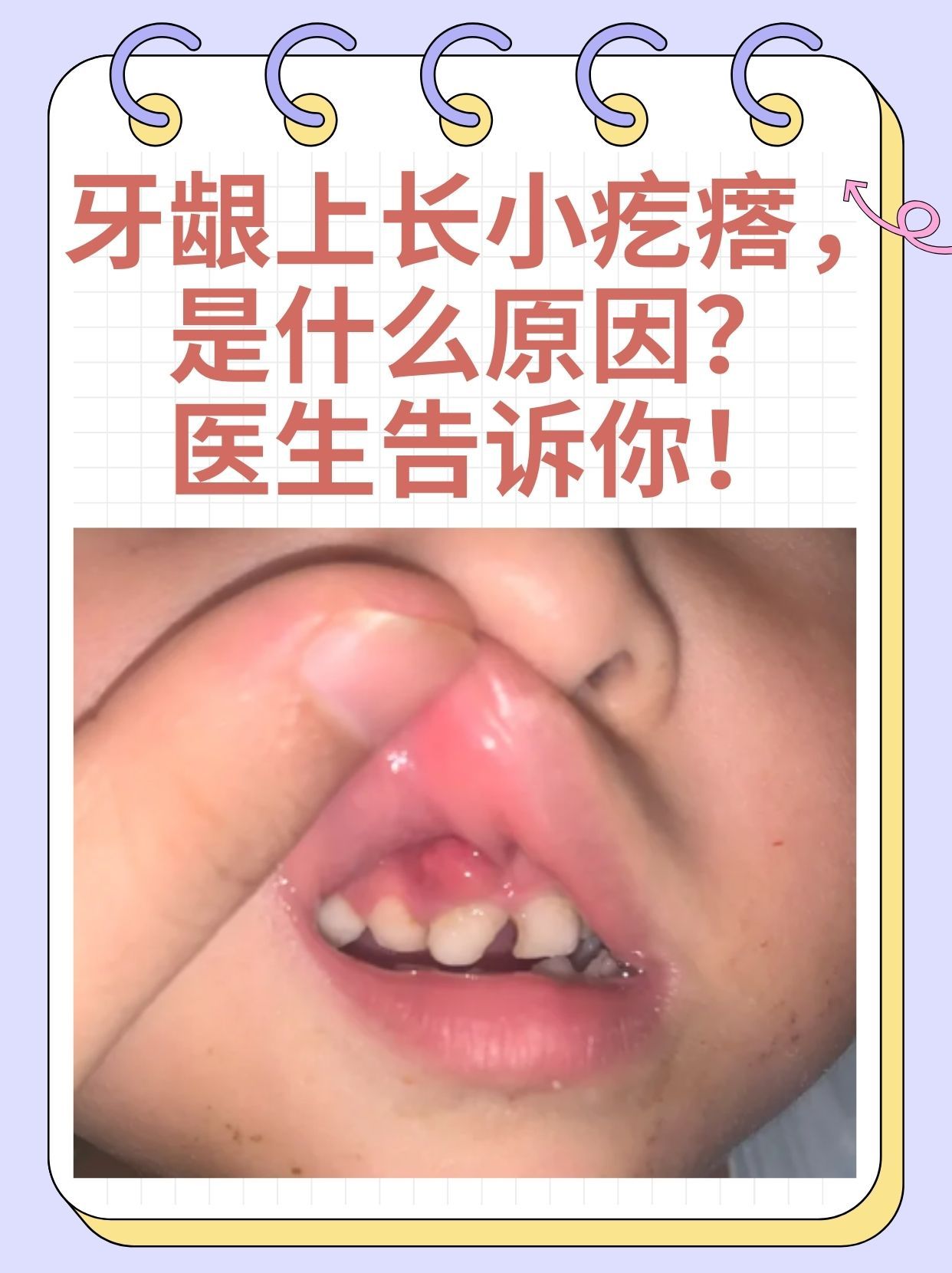 医生告诉你! 牙龈上长小疙瘩是一种常见现象,很多人都会经历这种症状