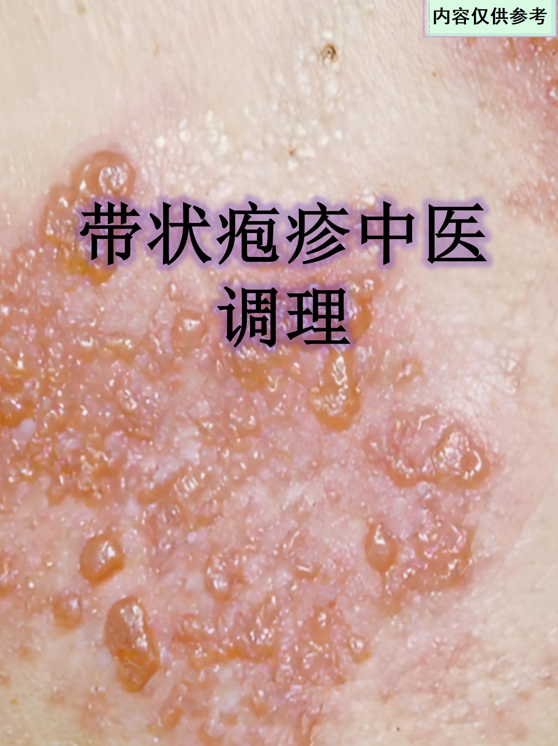 带状疱疹中医调理