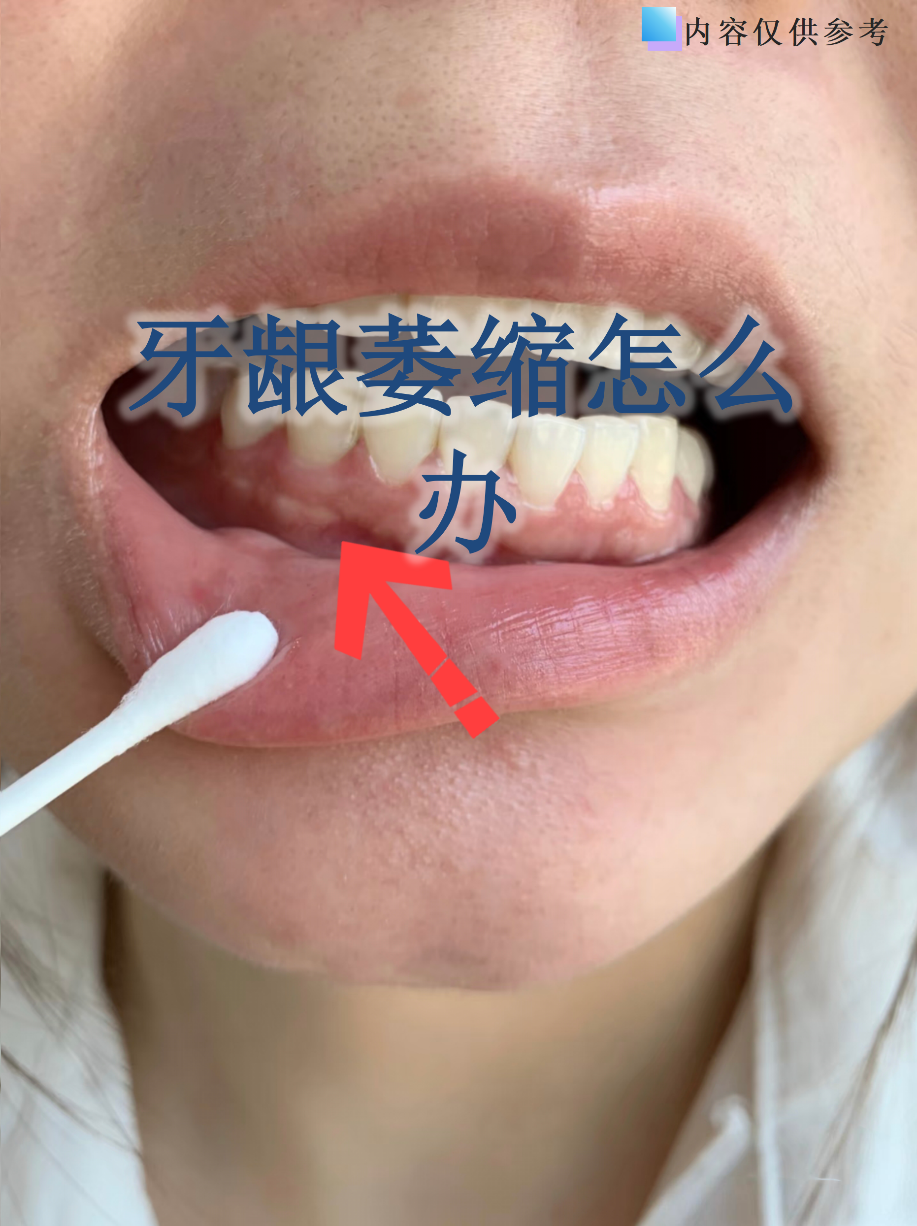 牙龈萎缩是许多人悄悄面临的牙齿健康问题,它会让