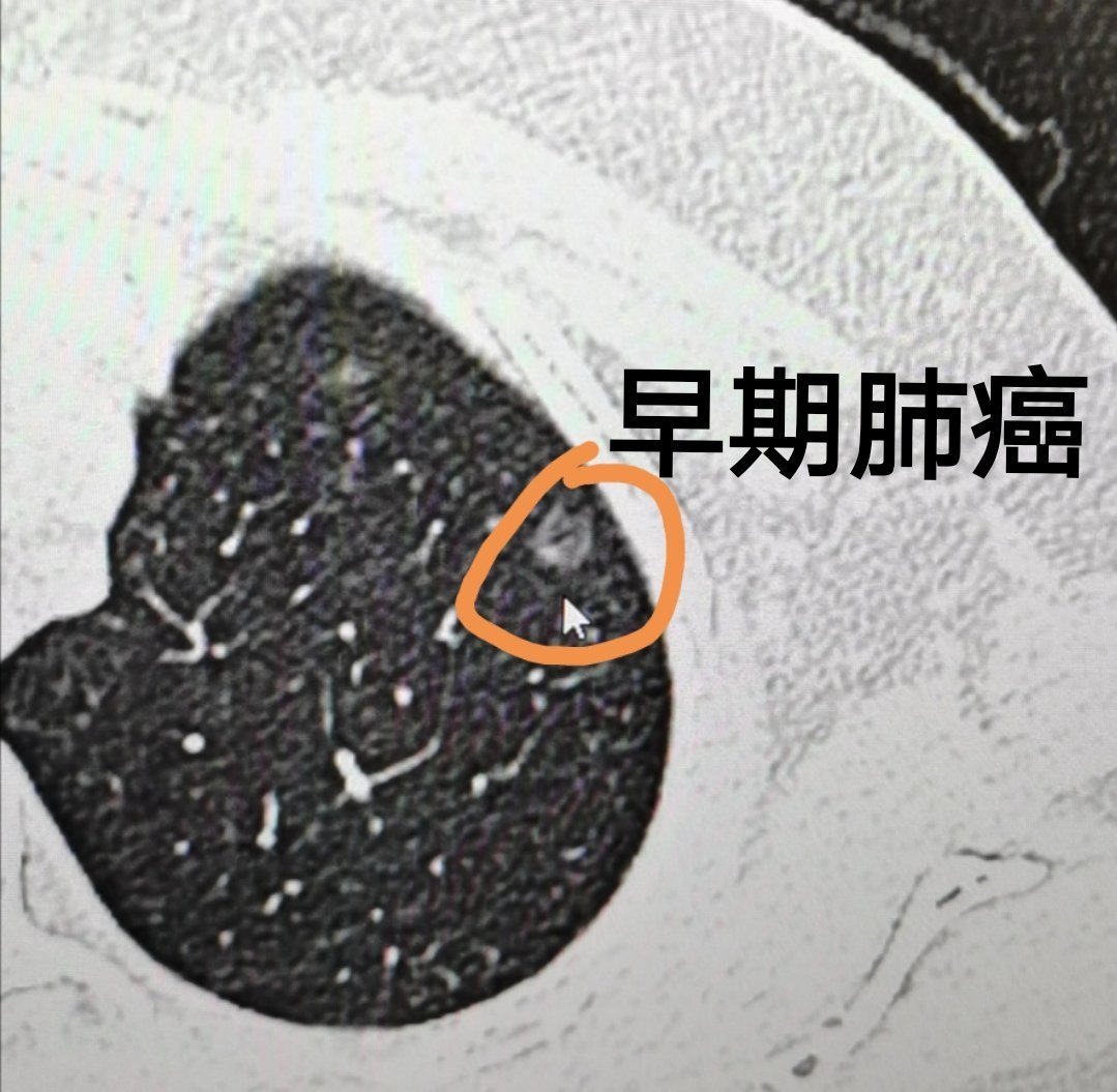 如果我们说的这个早期肺癌,是指"真正的"早期肺癌,也就是不典型腺瘤样