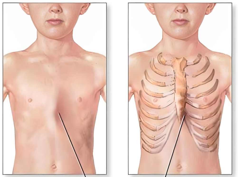 让我们先来认识这两种胸廓畸形:漏斗胸表现为胸骨向内凹陷,就像胸前