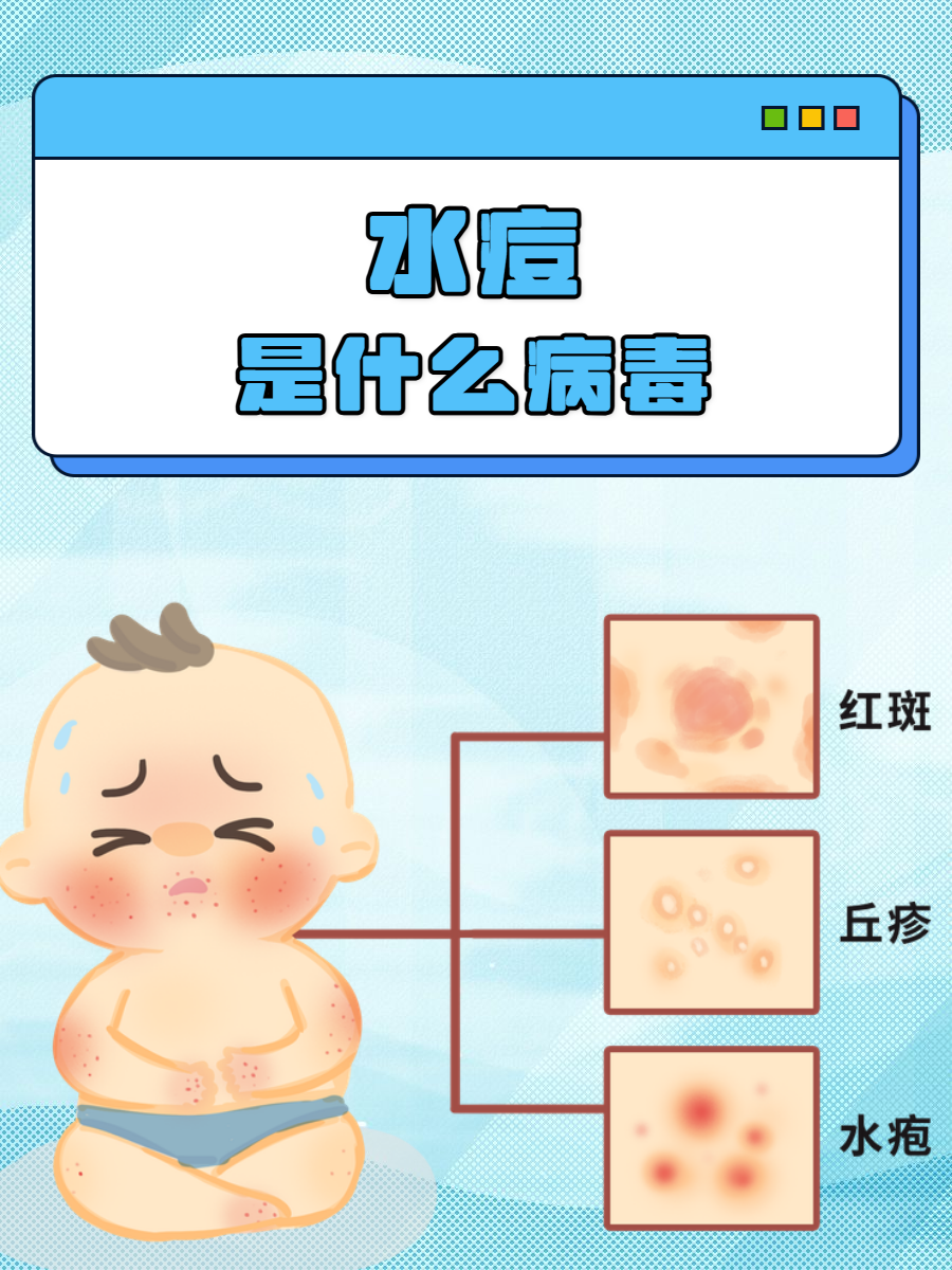 水痘是什么病毒?