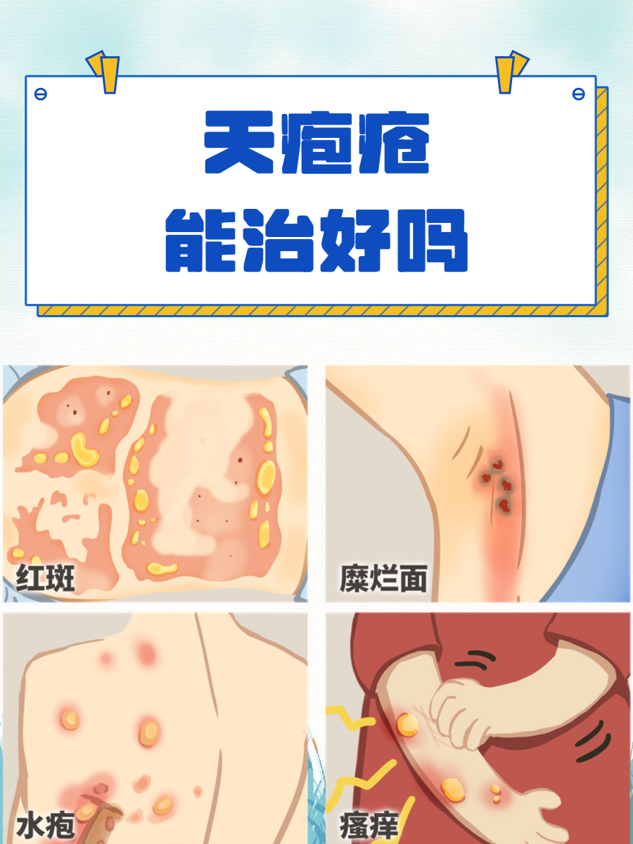 天疱疮能治好吗?