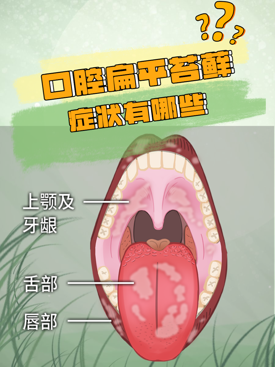 口腔扁平苔藓是一种比较常见的口腔黏膜慢性炎症性疾病,很多人发生该