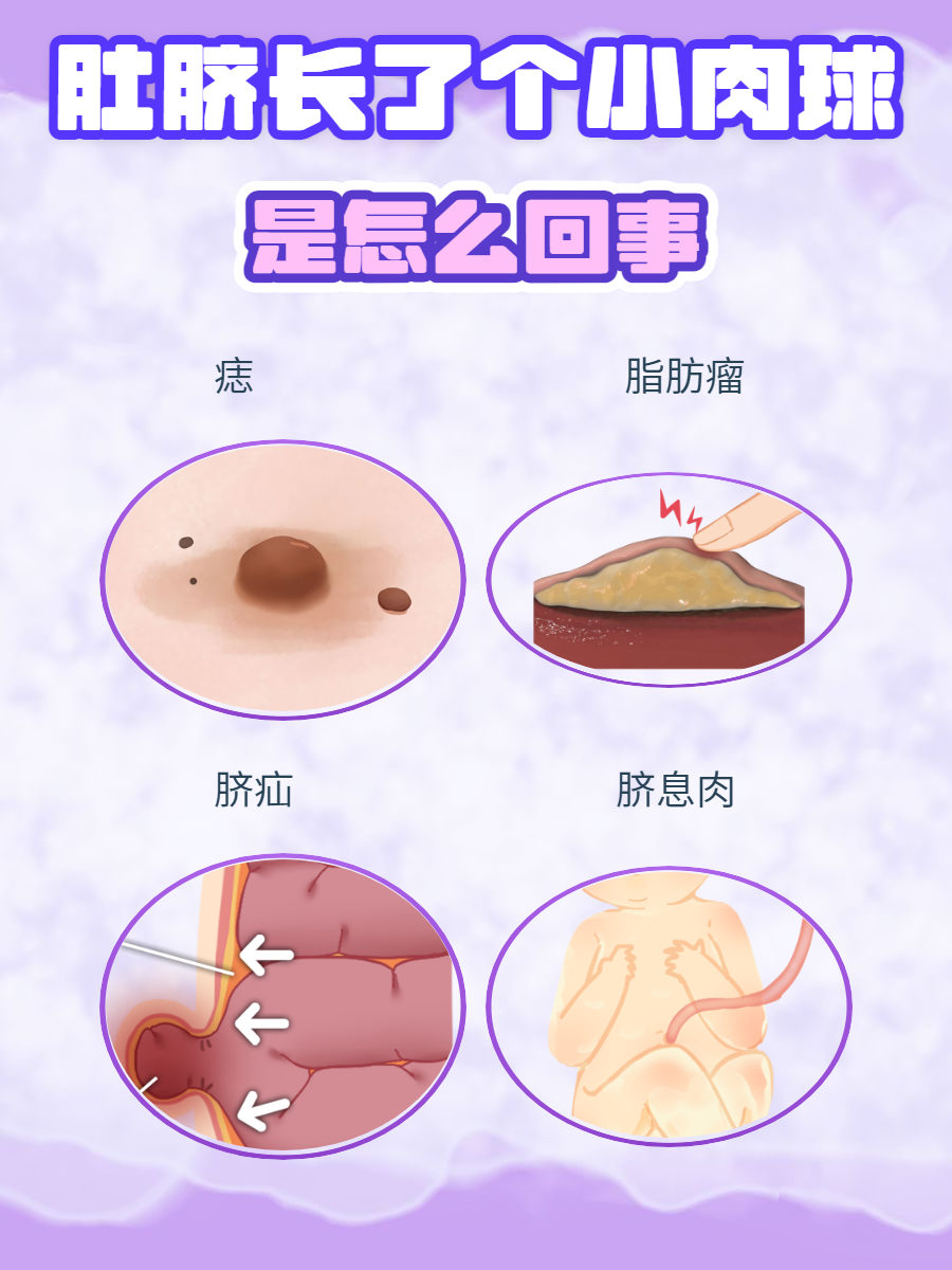 肚脐长了个小肉球是挺让人在意的事儿