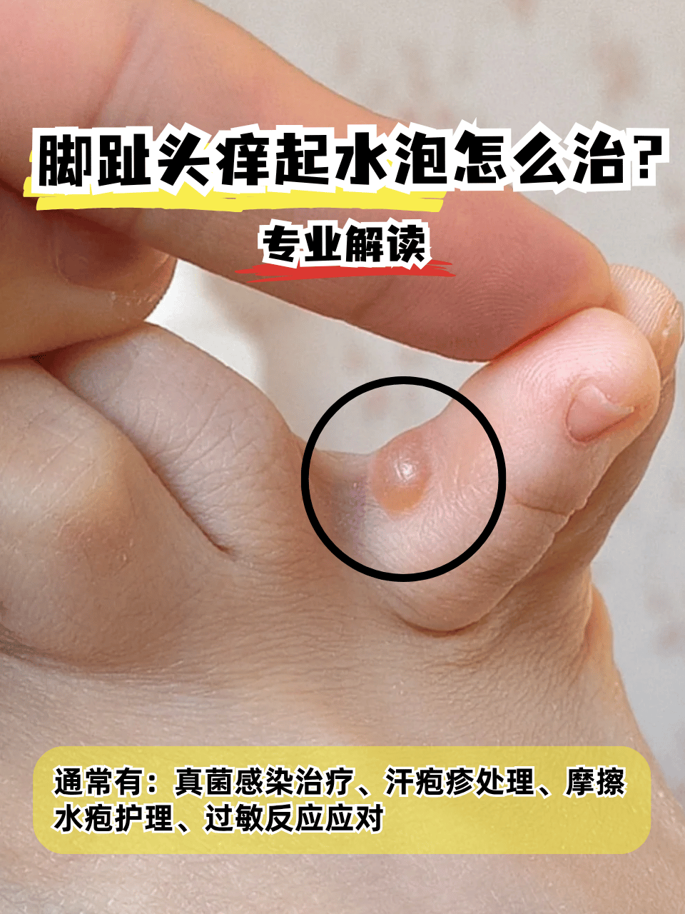 脚趾头痒起水泡怎么治?