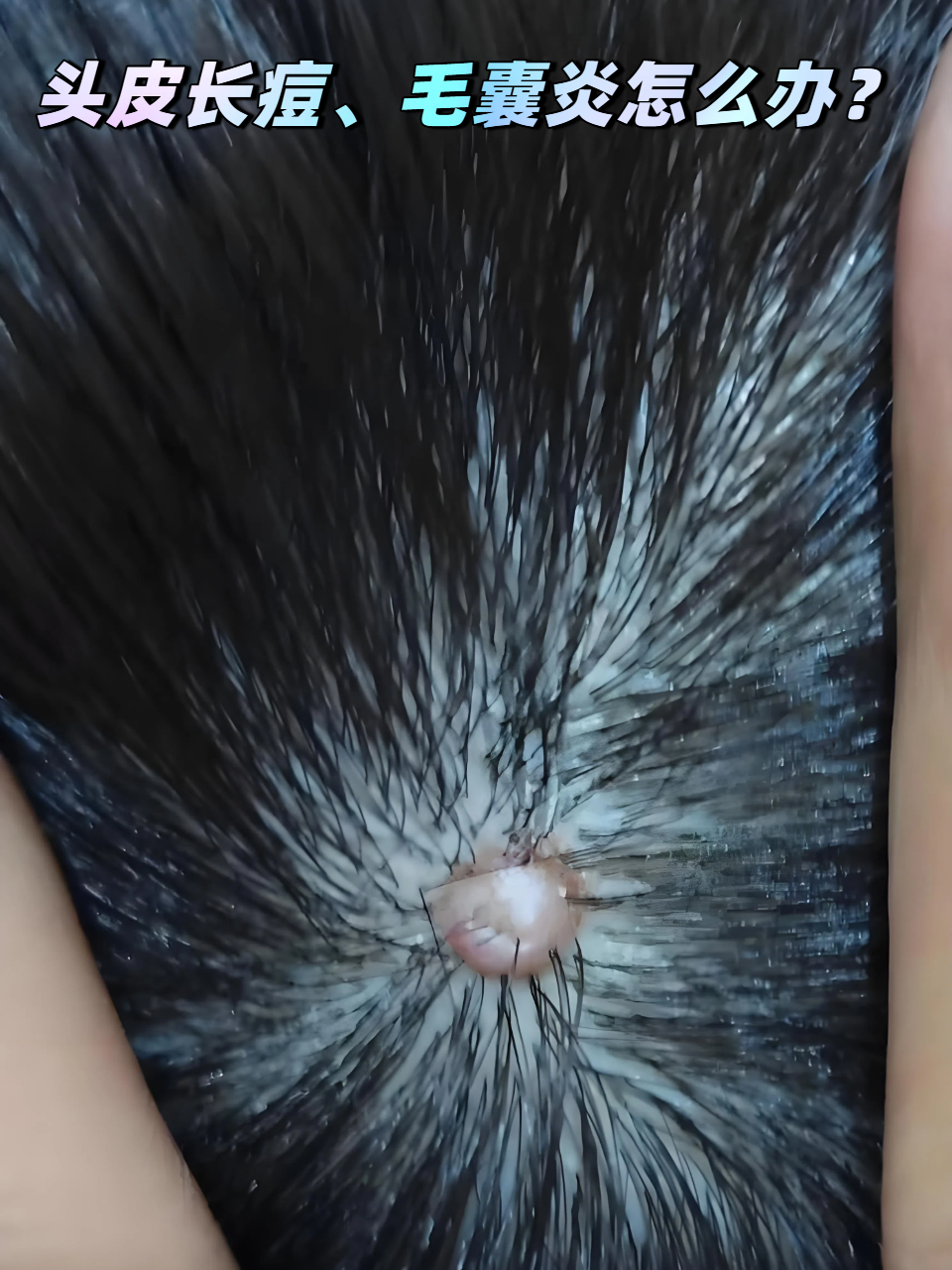 头皮长痘,毛囊炎怎么办?