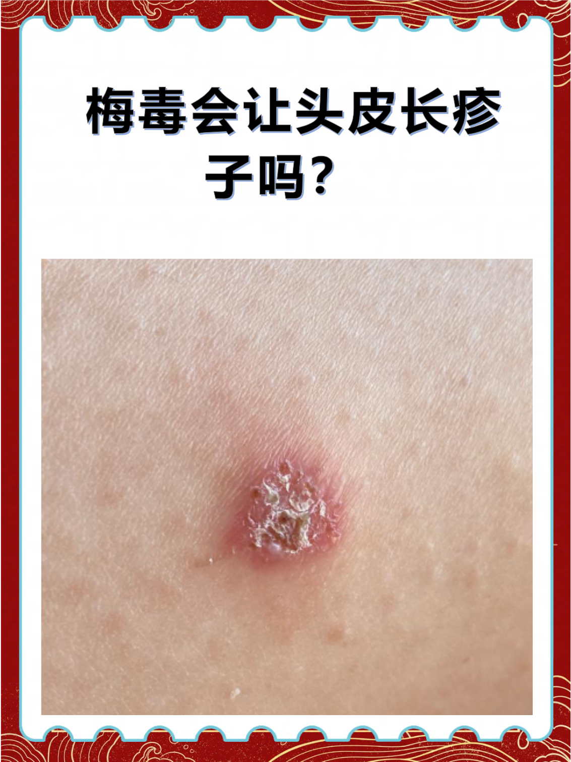 梅毒的皮肤表现 一期梅毒硬下疳:感染后2