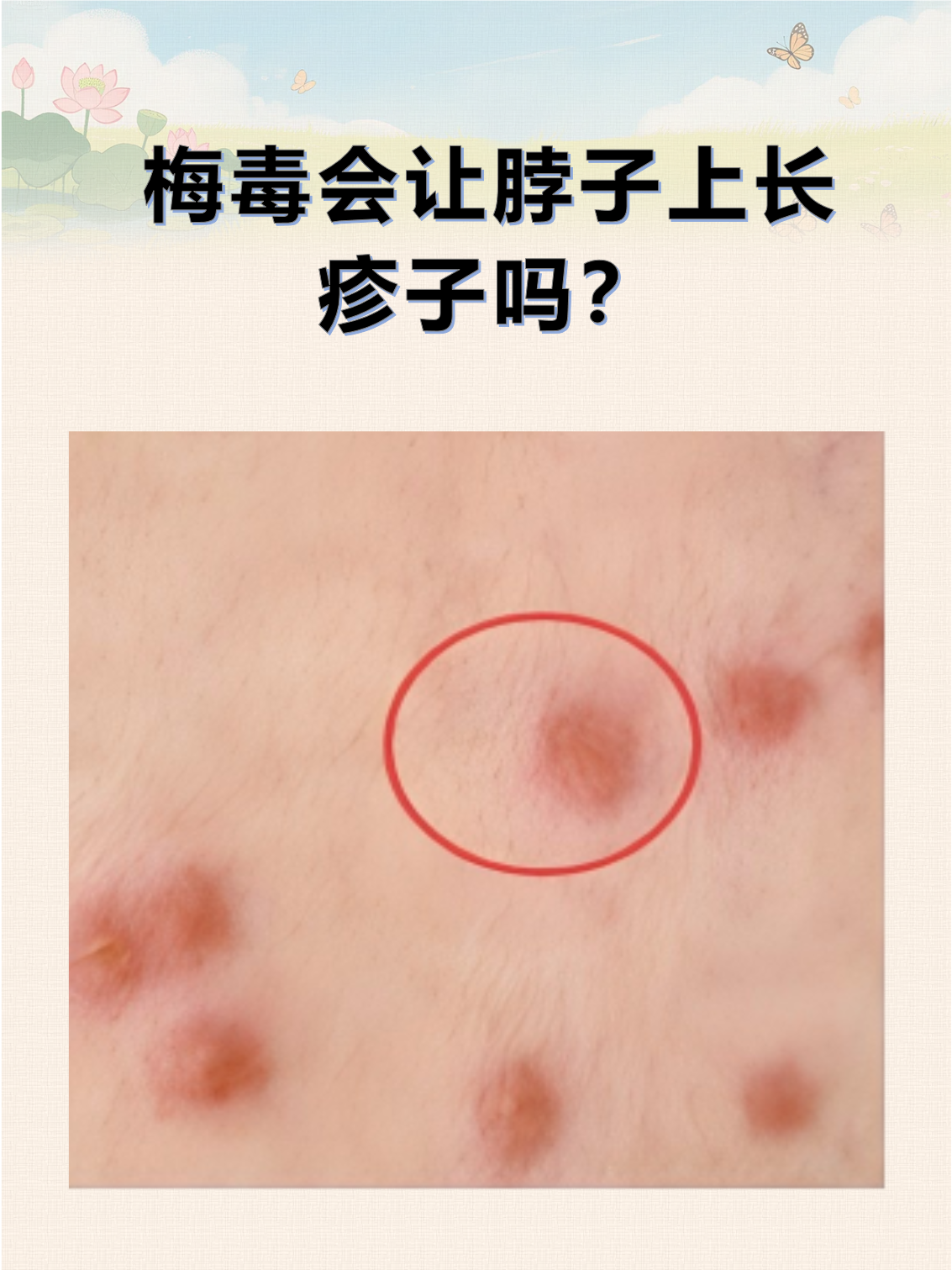 梅毒会让脖子上长疹子吗?