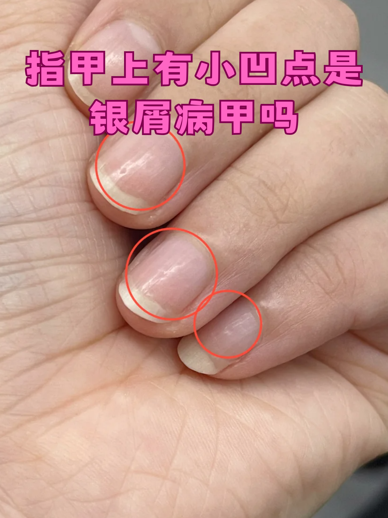 常见原因分析 真菌感染:甲板受真