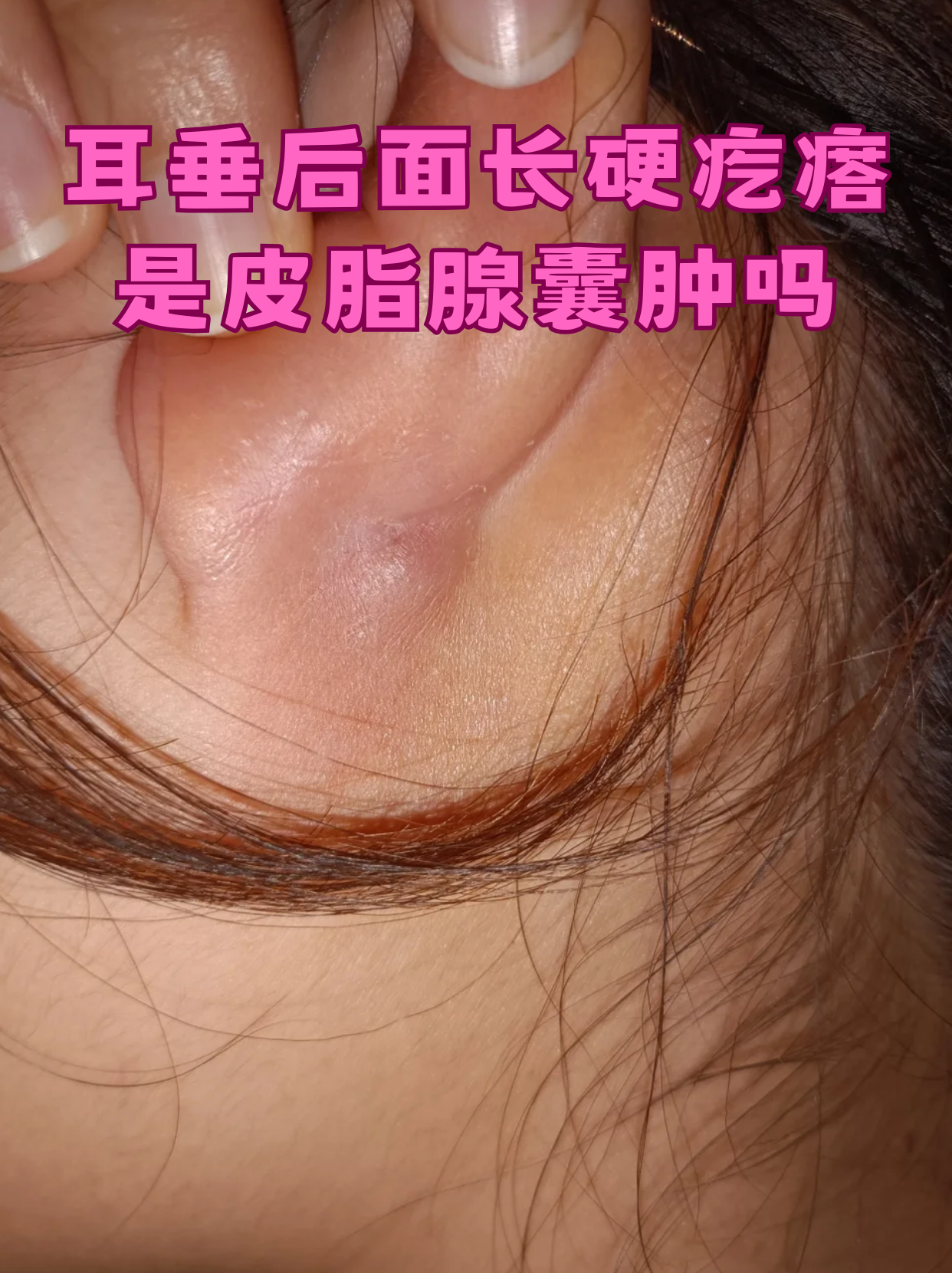 耳垂后面长硬疙瘩是皮脂腺囊肿吗