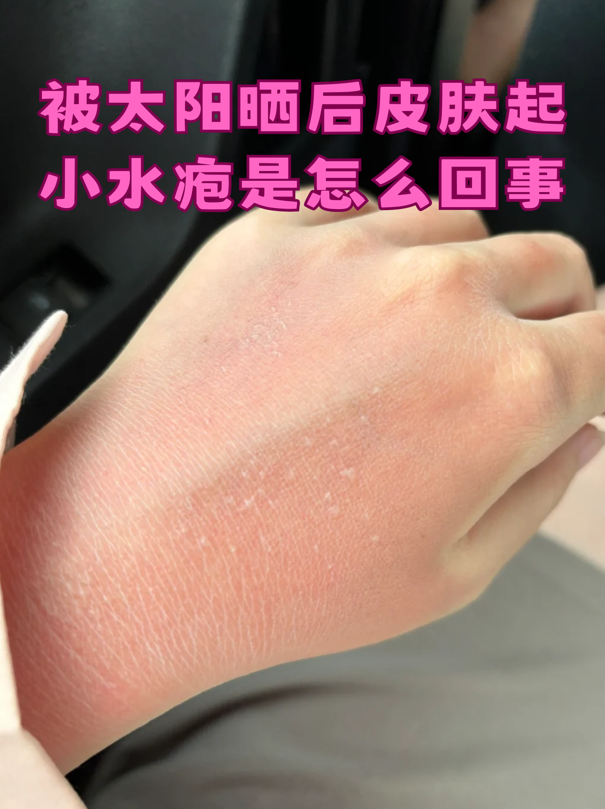 被太阳晒后皮肤起小水疱是怎么回事