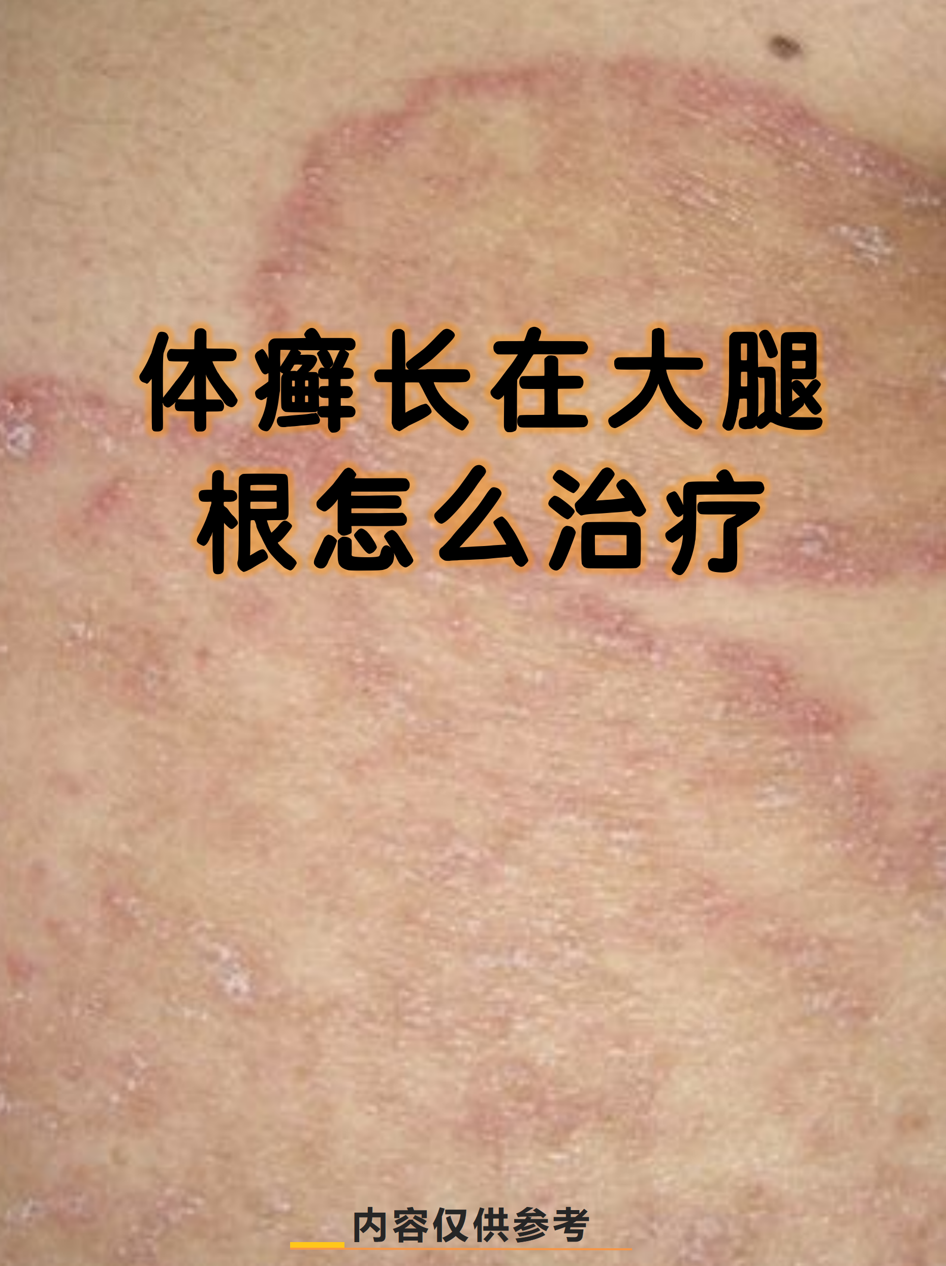 怎么治疗  体癣长在大腿根确实让人困扰,这种由真菌感染引起的皮肤病