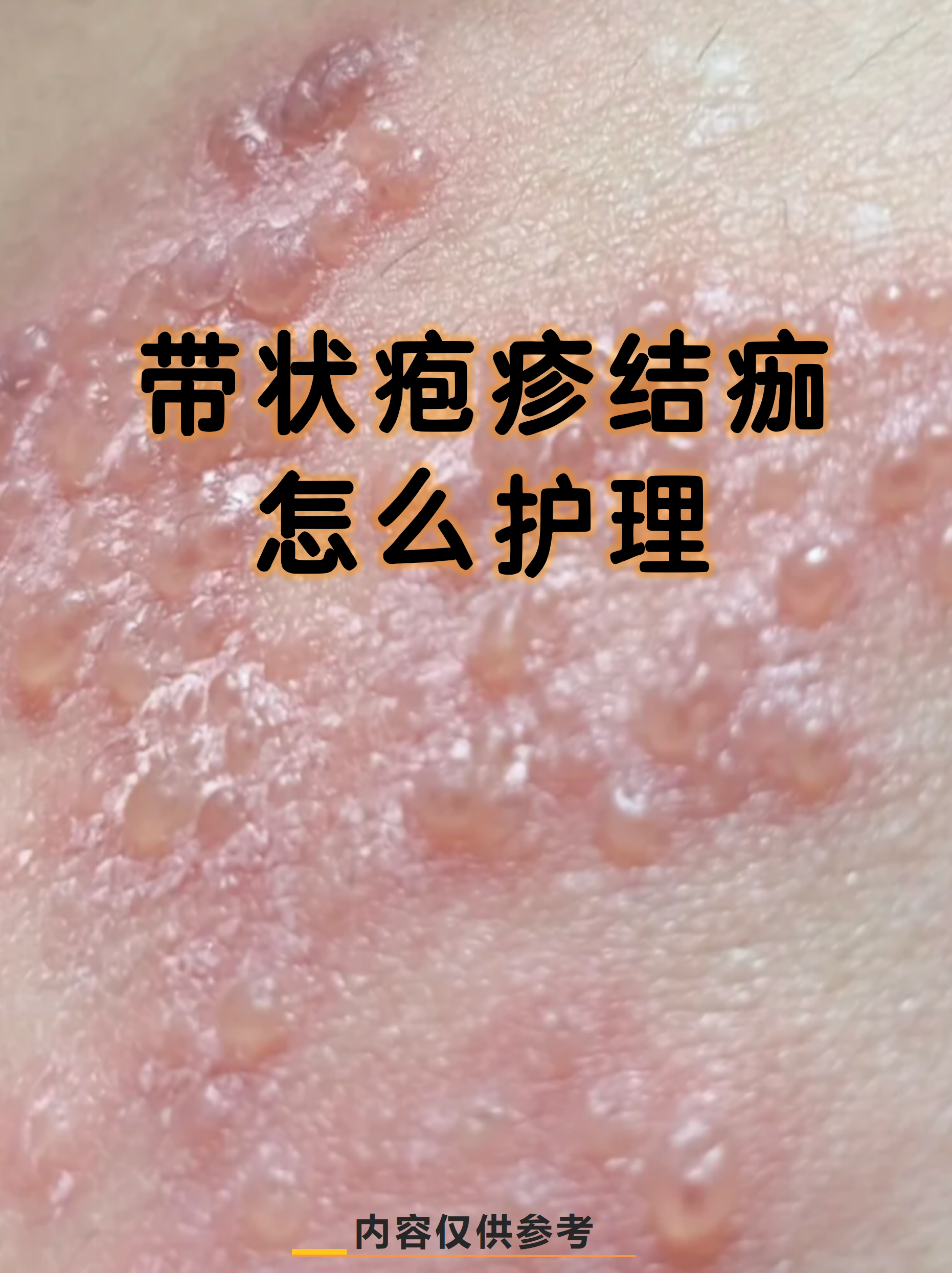 带状疱疹结痂怎么护理