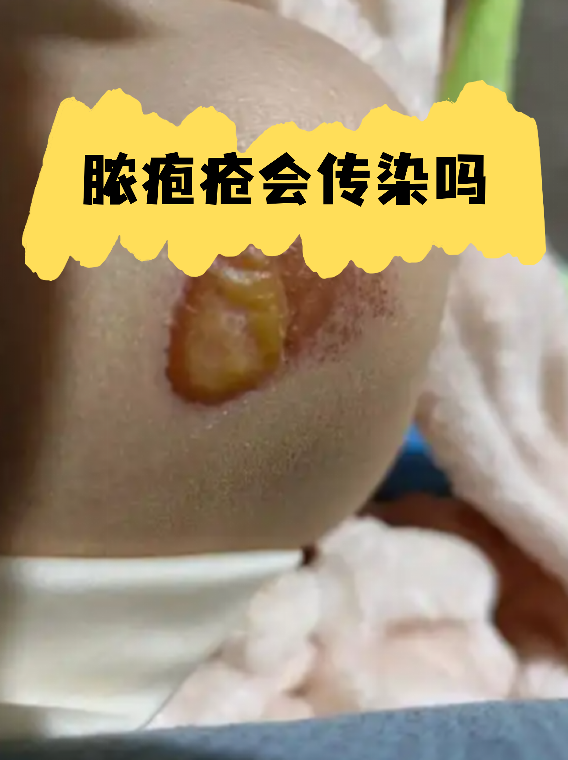 脓疱疮是一种常见的皮肤感染,很多家长发现孩子起