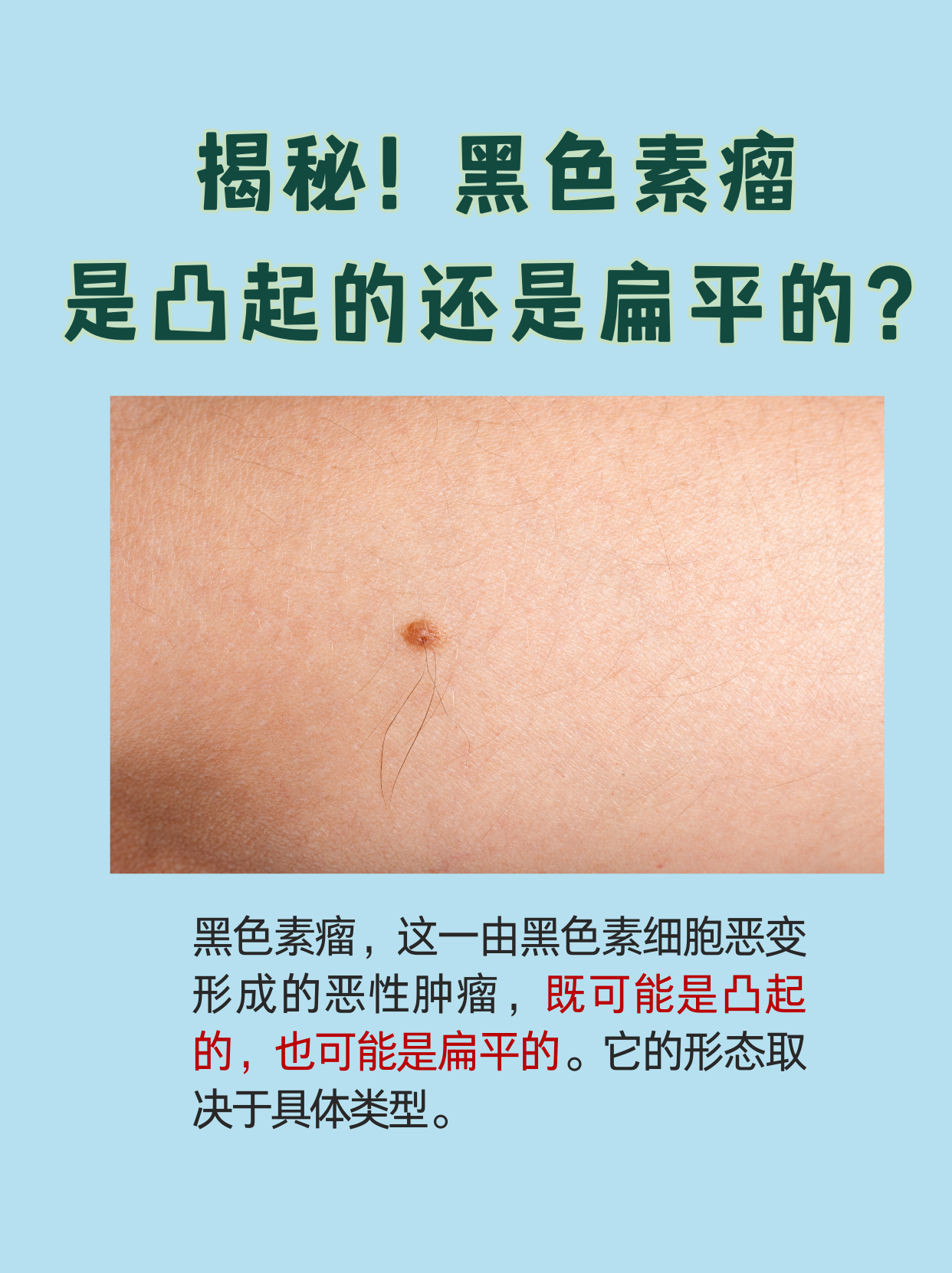 今天我们要探讨的是关于黑色素瘤的一个常见疑问:黑色素瘤究竟是凸起