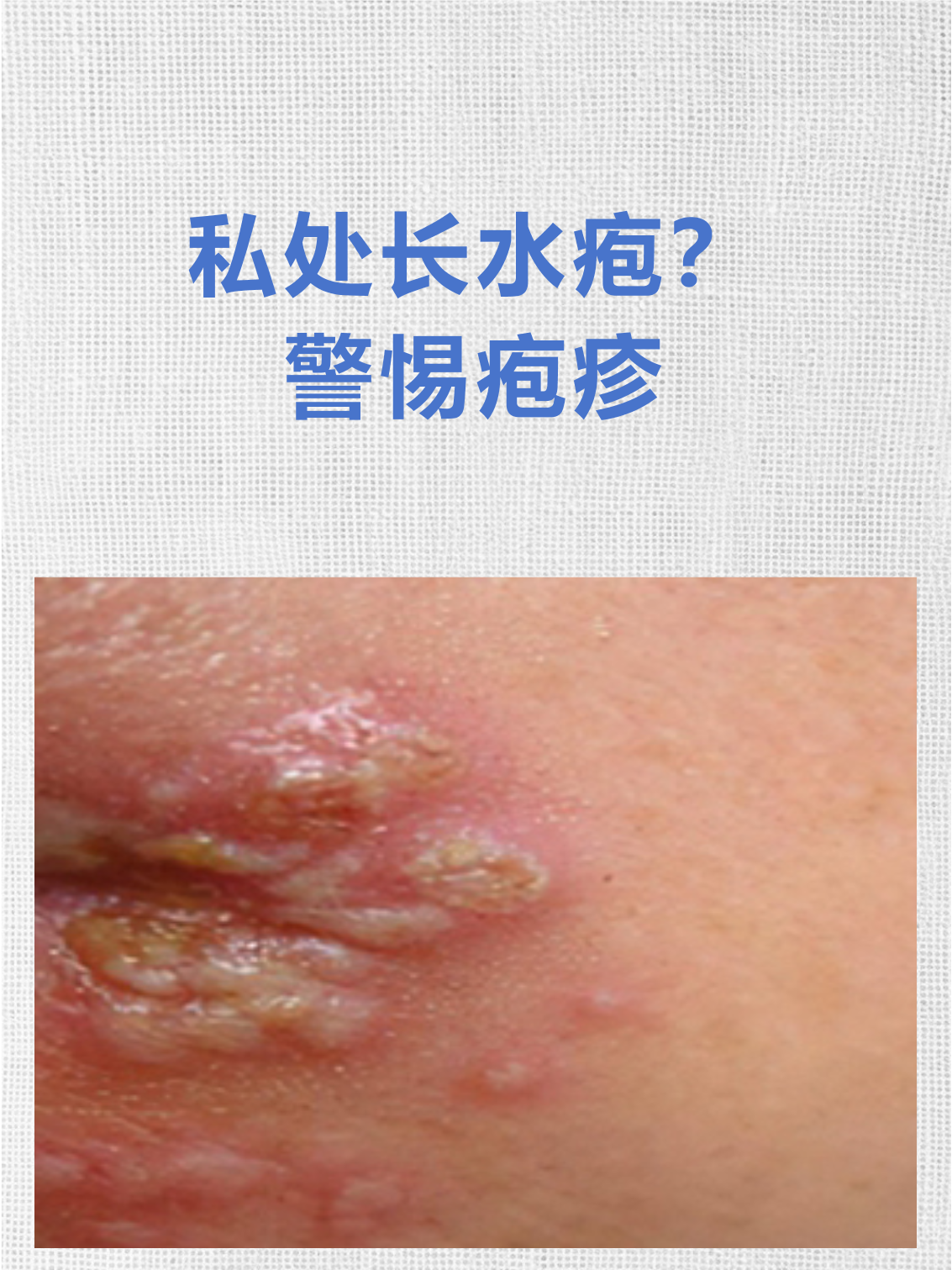 私处疱疹典型症状 簇状水疱:初期为红斑,1