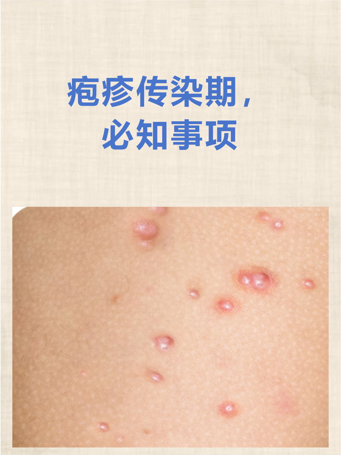 疱疹传染期确实需要格外注意,这种病毒在特定