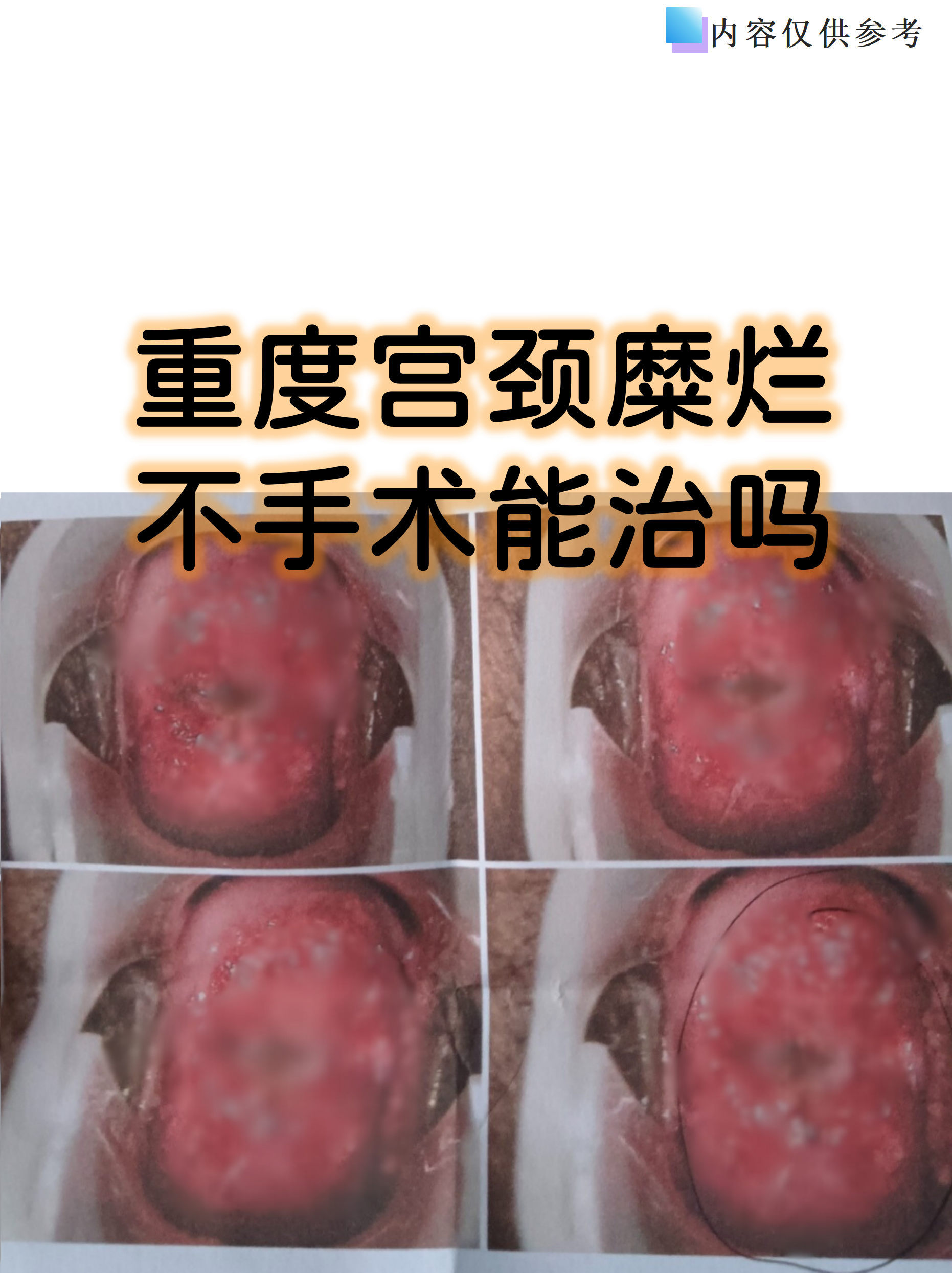 重度宫颈糜烂不手术能治吗