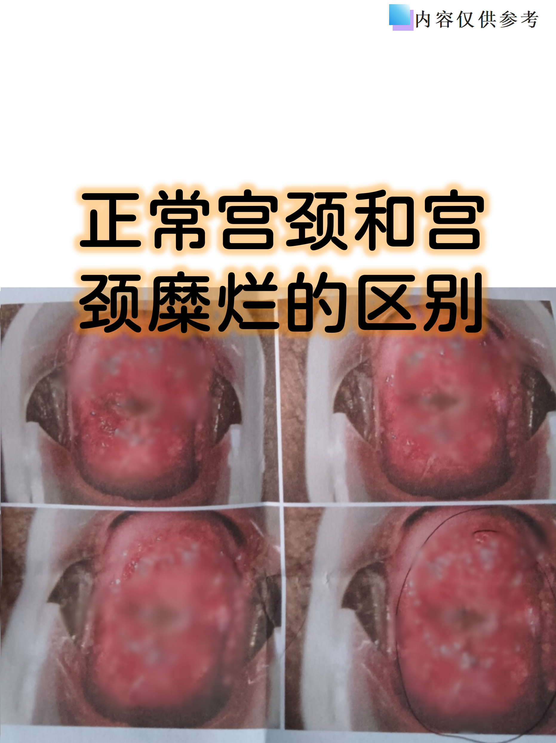 正常宫颈和宫颈糜烂的区别