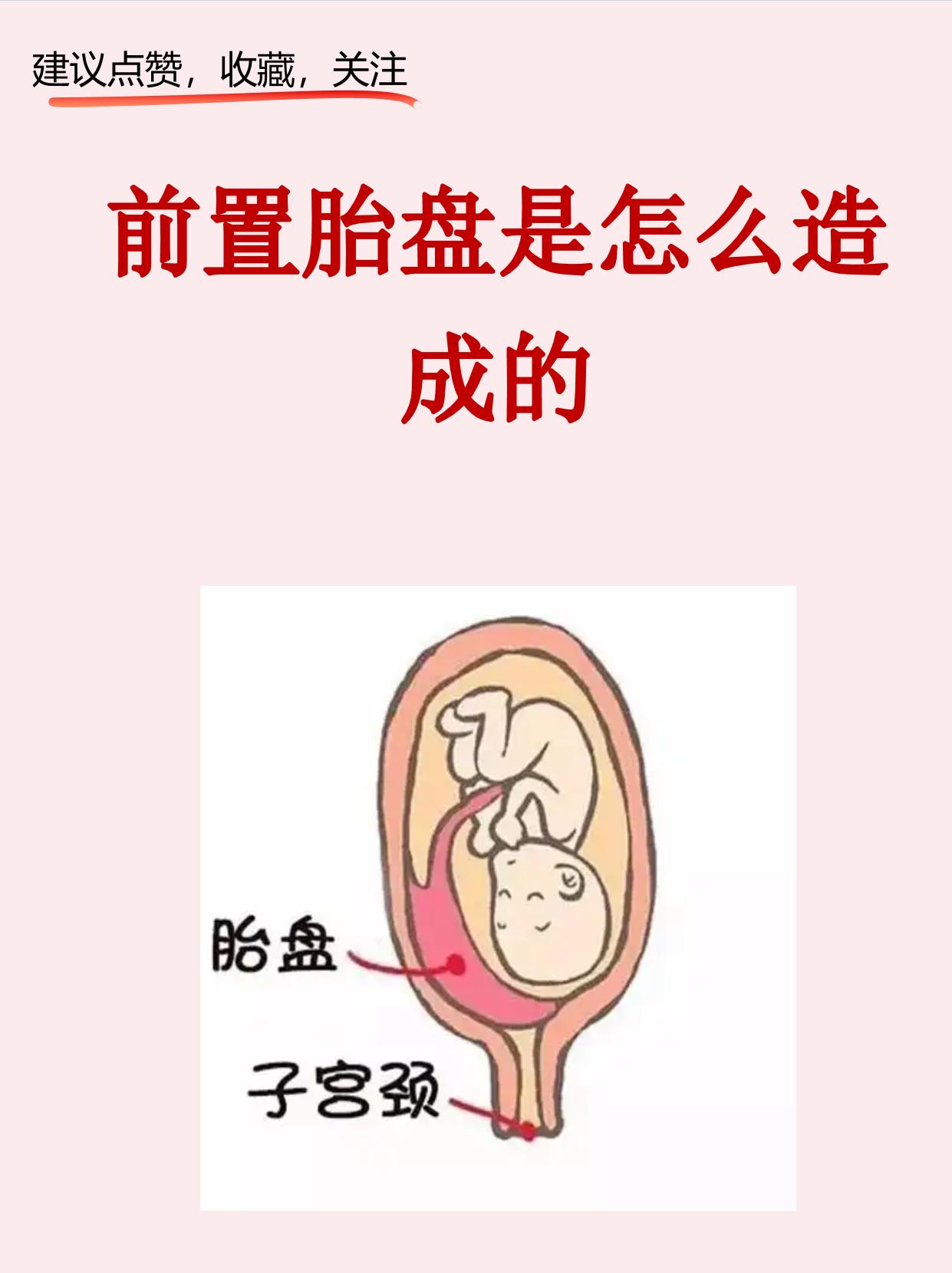 前置胎盘是孕期一种危险情况胎盘附着在子宫