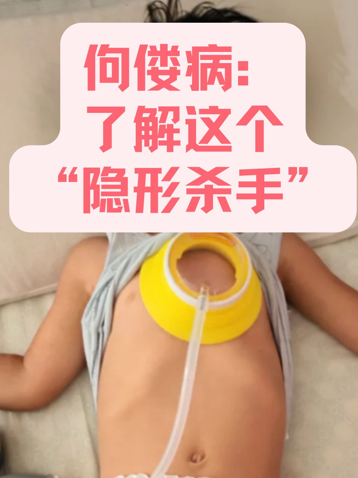 平躺肋骨正常图佝偻病儿童图片佝偻病长大后图片怎么判断是不是佝偻病