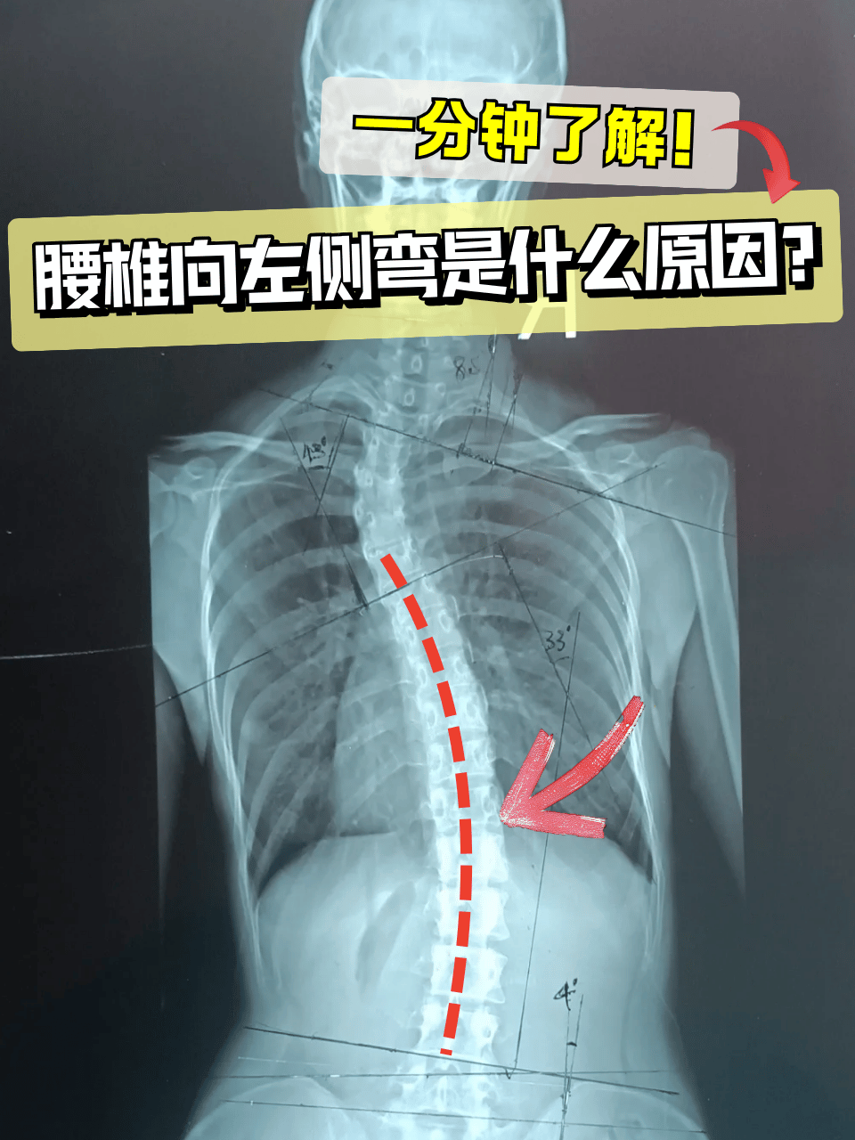脊柱侧弯正常和不正常脊椎图片脊柱弯曲图片腰椎侧弯图片正常腰椎图片