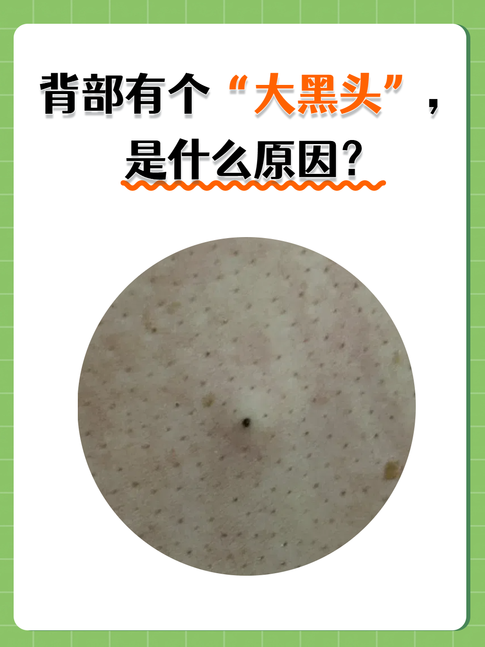 你有没有出现过背部有个"大黑头"的情况呢?