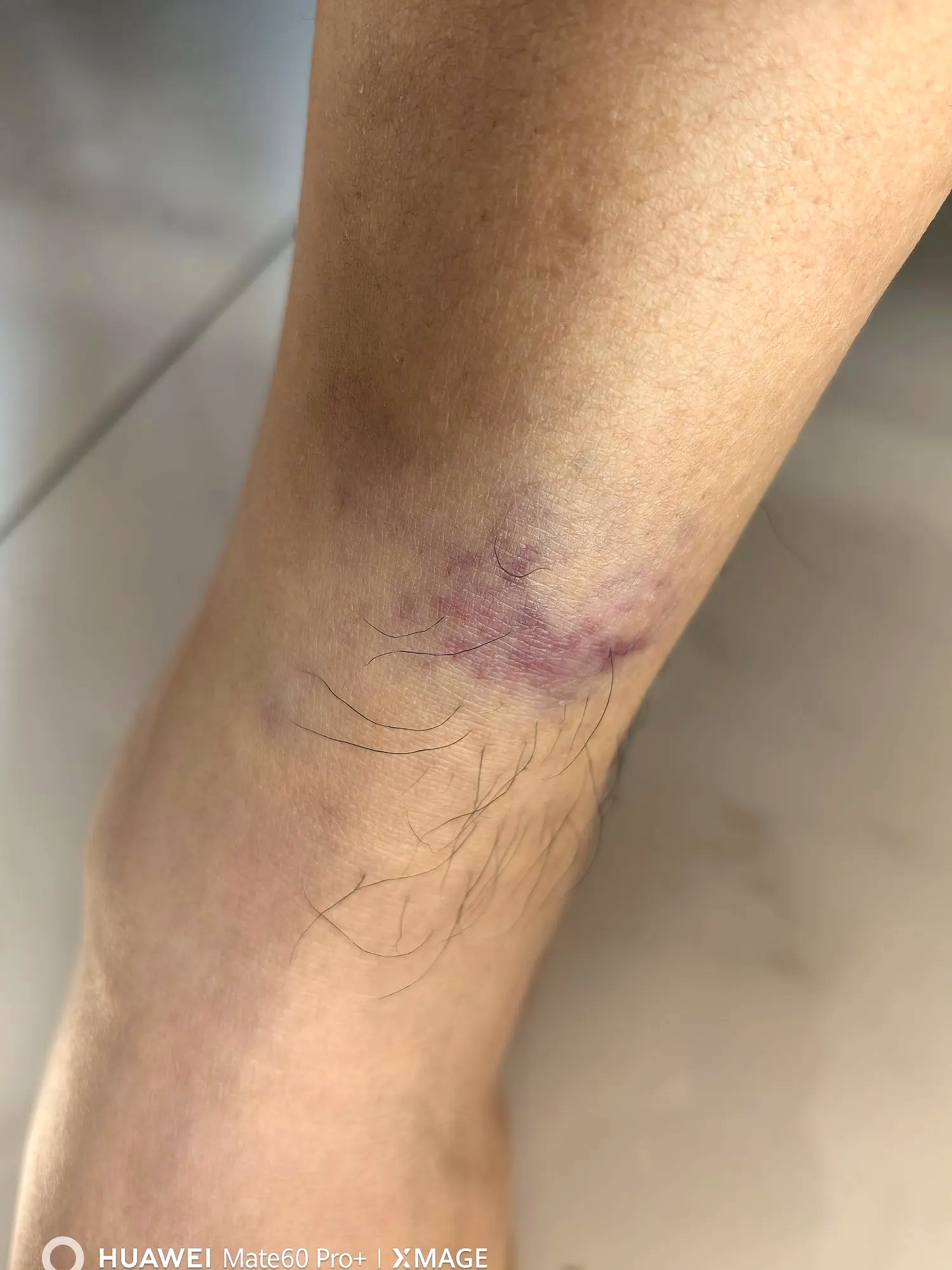 吃双抗的副作用越来越明显了,普通磕碰一下,脚腕