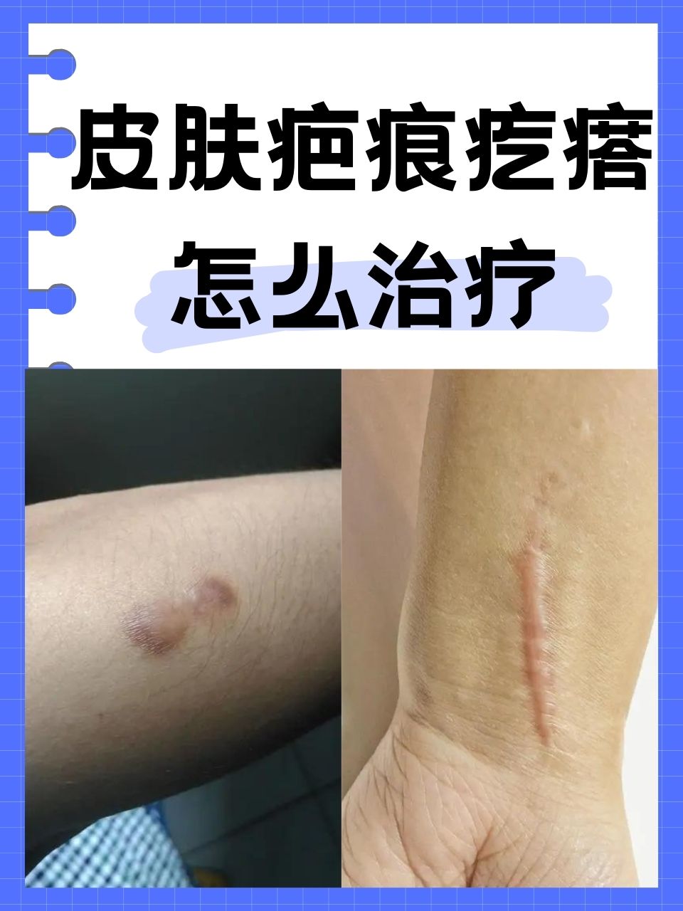 皮肤疤痕疙瘩怎么治疗 皮肤疤痕疙瘩常常给人们带来困扰,它不仅影响