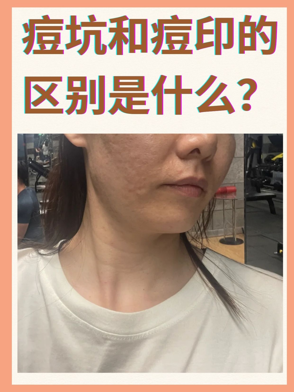 痘坑和痘印的区别是什么?