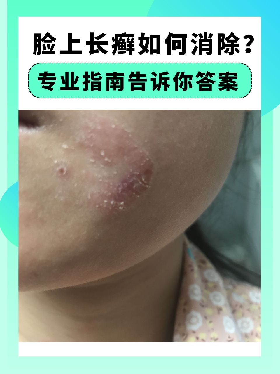 脸上长癣如何消除?