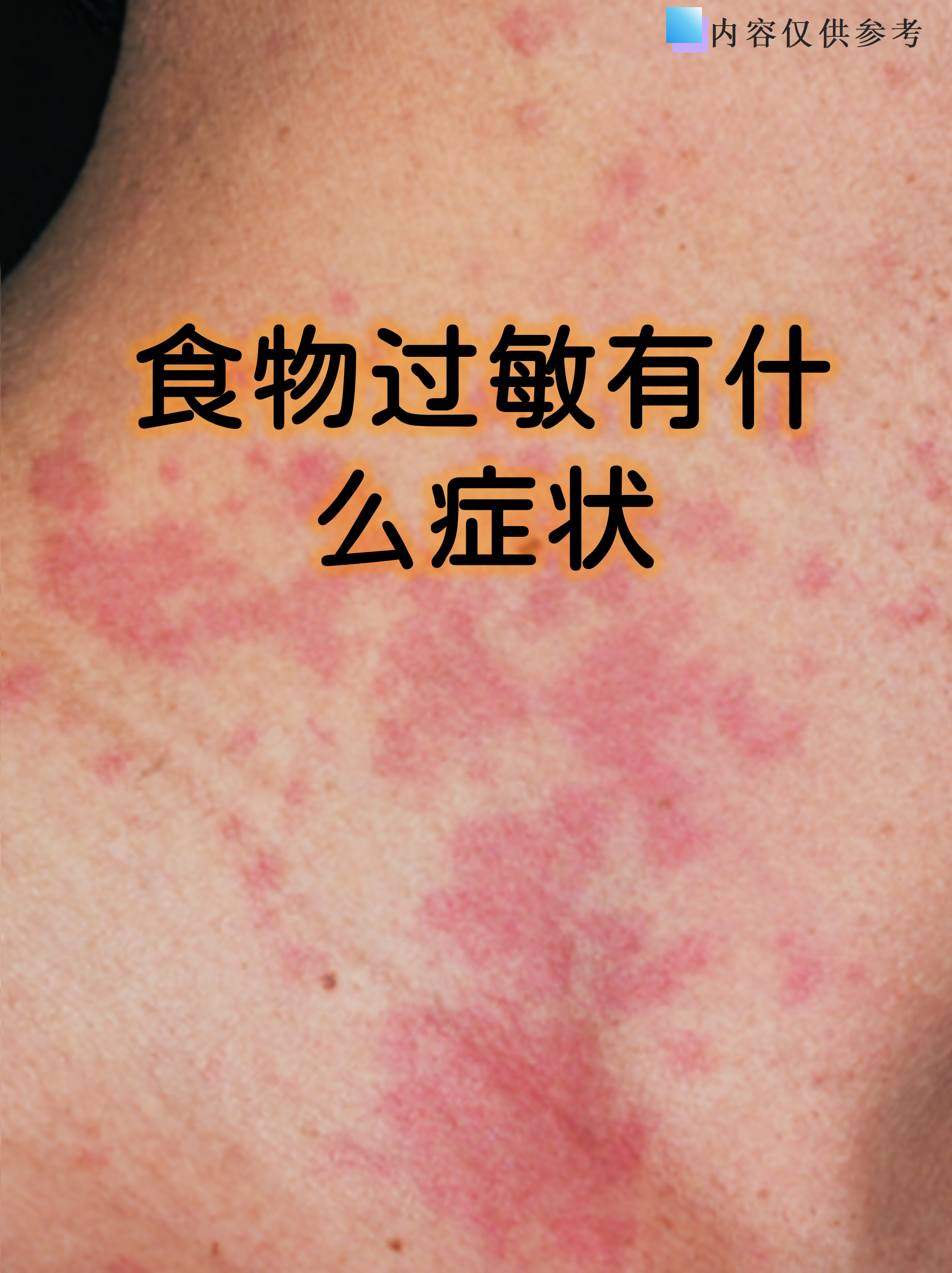 食物过敏是免疫系统对特定食物产生的异常反应