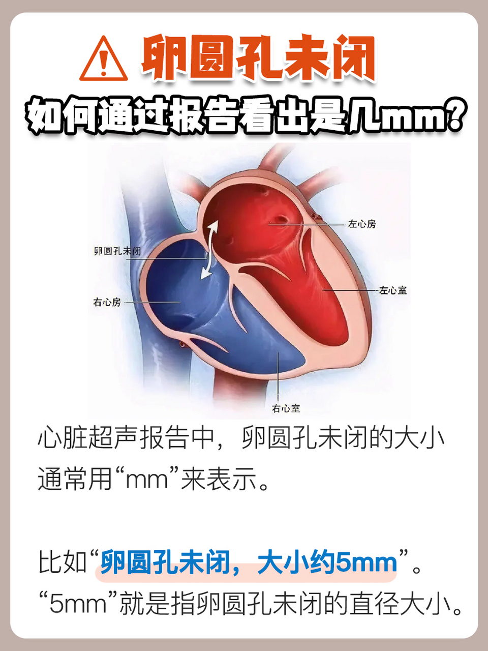 卵圆孔未闭解剖图图片