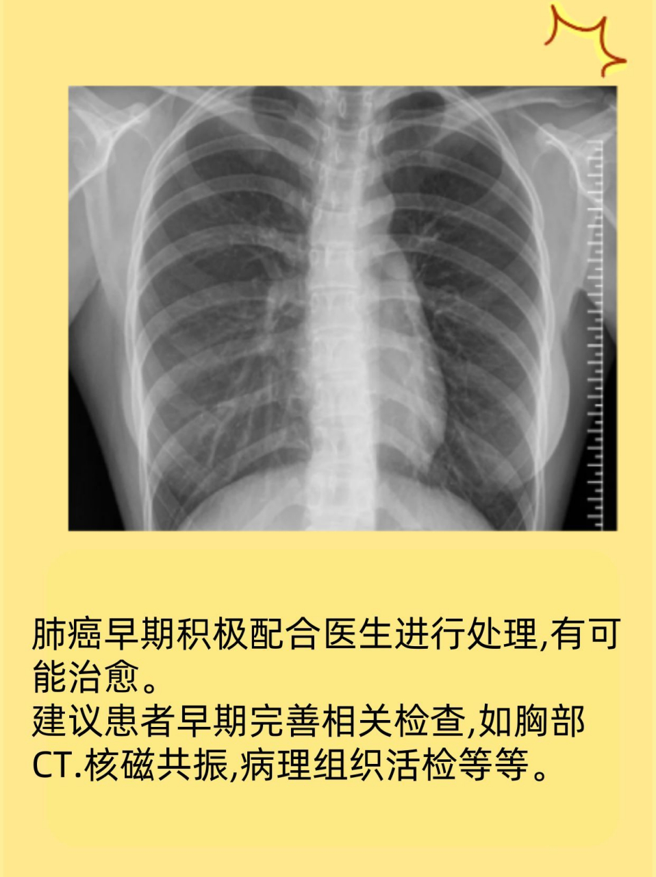 肺癌x光片图片早期图片