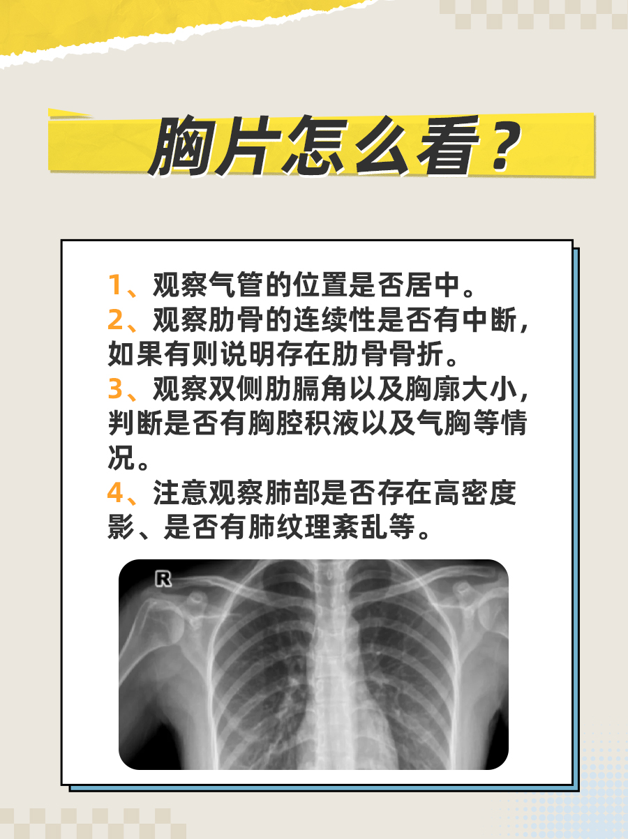 胸片检查,也称为x线胸片,是一种常规且重要的医学影像学检查方法