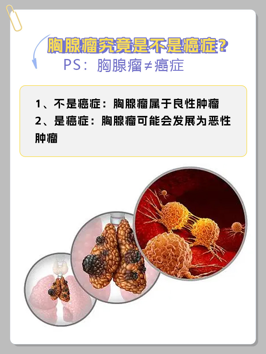 胸腺瘤是癌症吗?