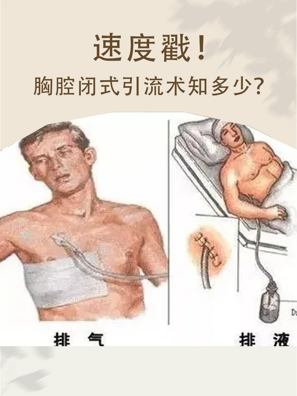 71胸腔闭式引流术知多少?