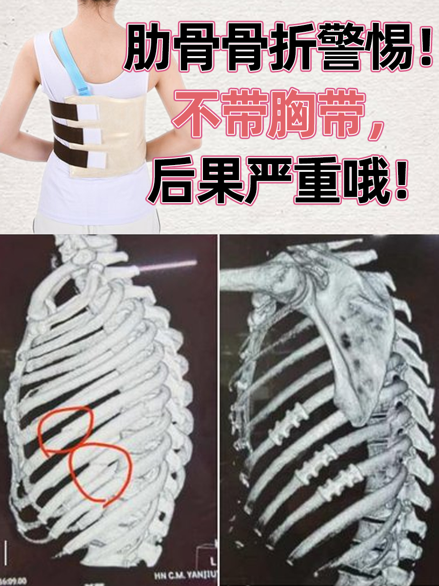 肋骨骨折,这一常见的外伤情况,往往由于外力直接作用或间接压力引起