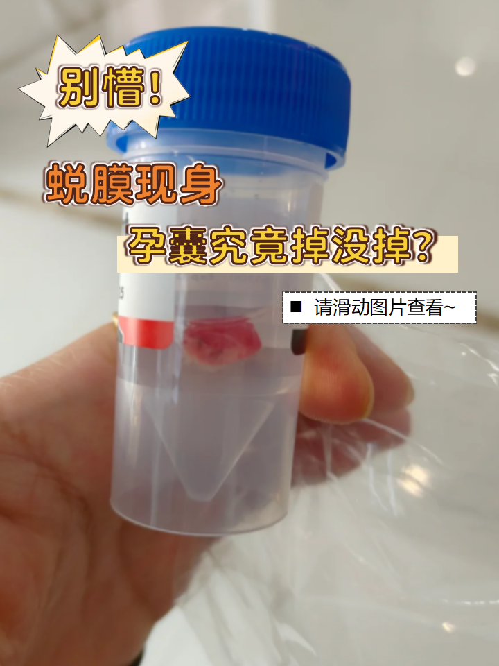 蜕膜现身,孕囊究竟掉没掉?