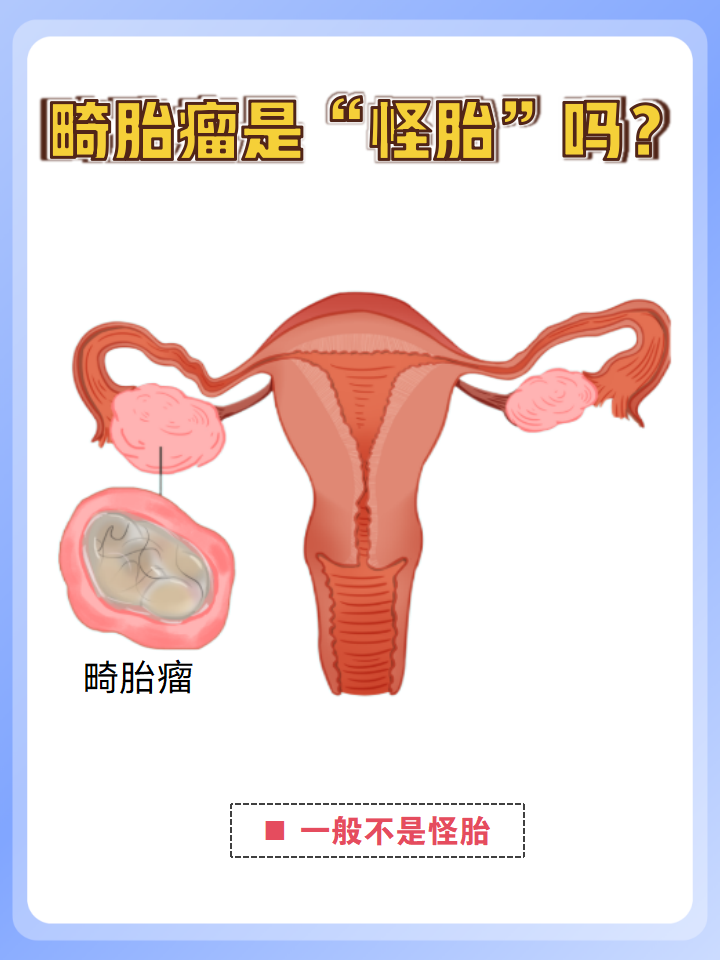 为什么会长卵巢畸胎瘤和囊肿为什么在线