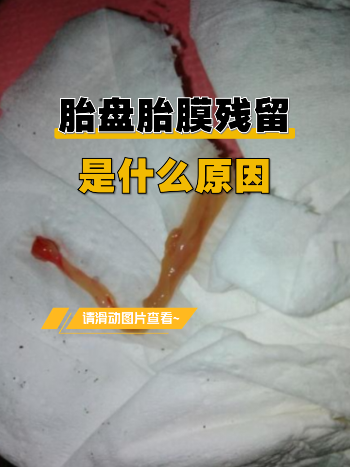 胎盘胎膜残留是什么原因