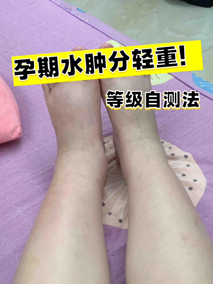 非凹陷性水肿生理性水肿是怎样的轻度水肿怎么判断妊娠水肿分级妊娠期