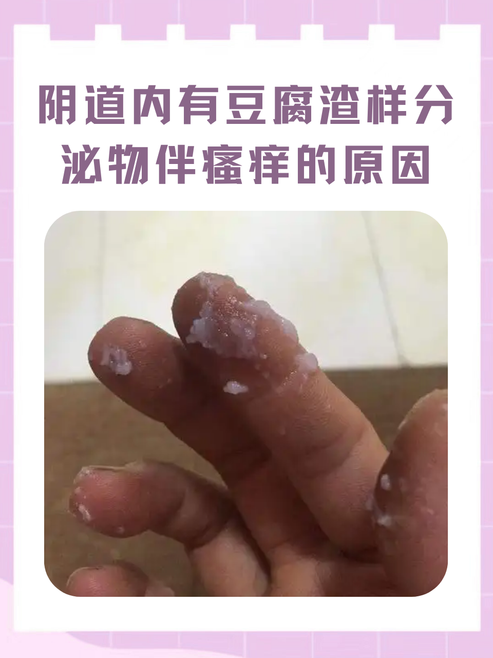 常见原因 霉菌感染:白念珠菌过度繁殖会导致分泌