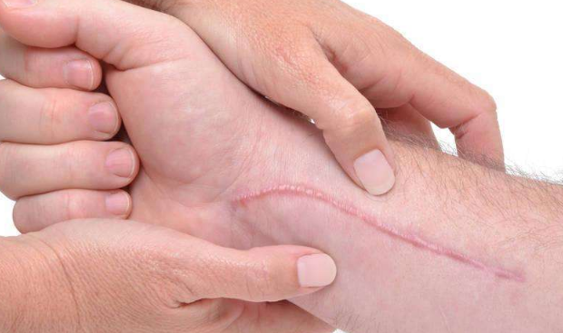 瘢痕疙瘩不治有危险吗?警惕这些潜在健康风险! 瘢痕疙瘩,常称"蟹足肿"