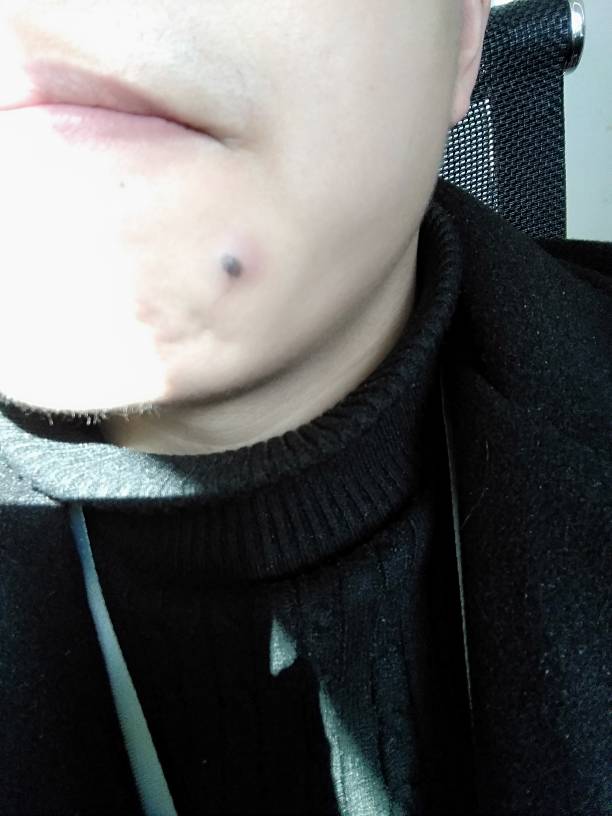 5个常见原因解析 皮肤上出现黑色凸起,可能是痣,疣或其他皮肤增生物