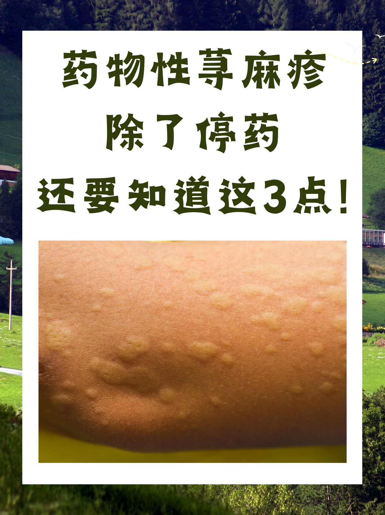 药物性荨麻疹是一种常见的药物不良反应,通常表现