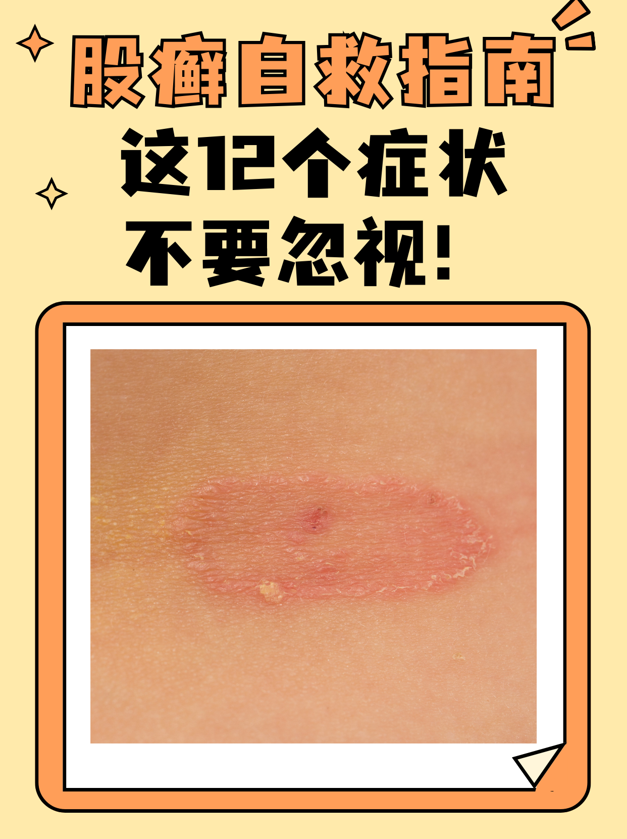 大腿腹股沟淋巴瘤图片图片