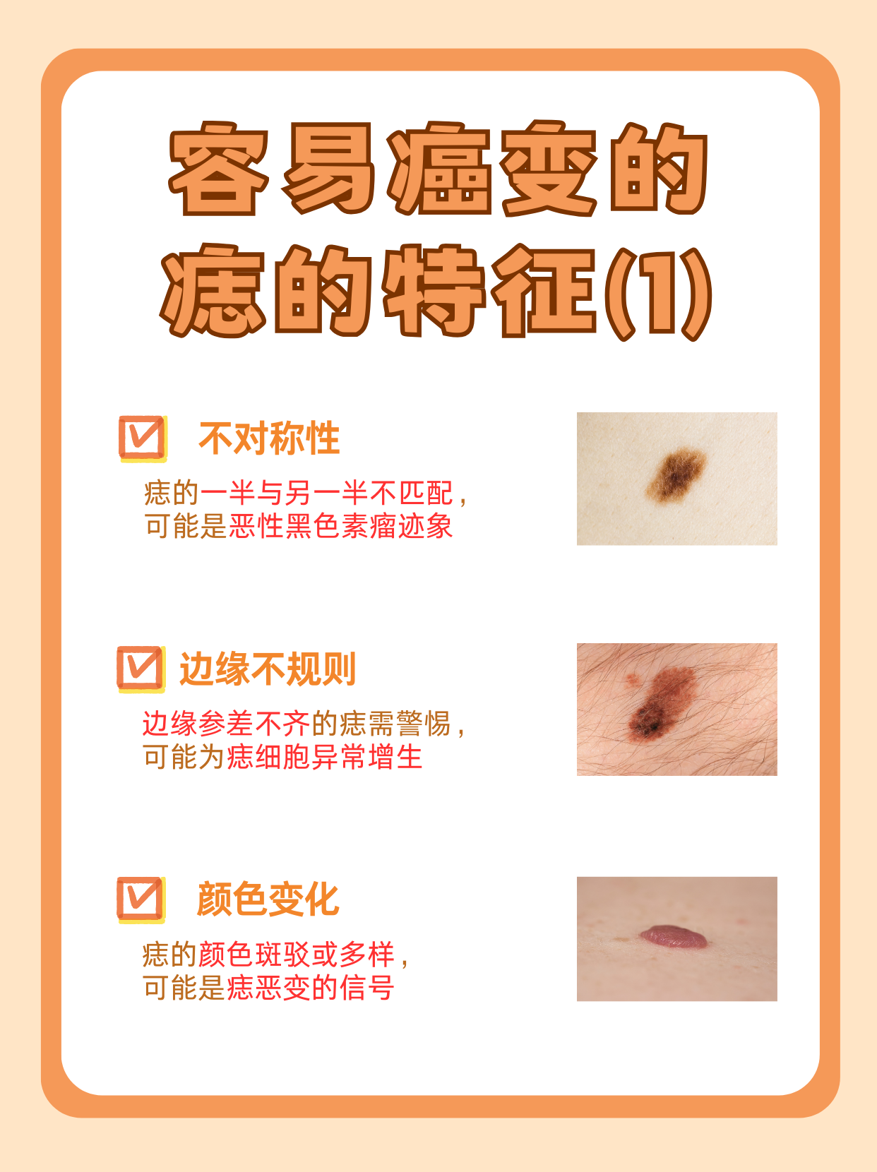 容易癌变的痣的特征与预防